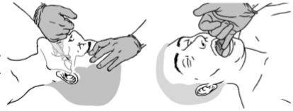 APNEE OSTRUTTIVE DEL SONNO: BENEFICI DI UNA SPECIFICA TECNICA OSTEOPATICA